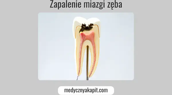 Zakażenie od zęba: Objawy ogólnoustrojowe i groźne powikłania