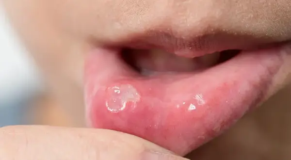 Afta u dentysty? Kiedy wizyta jest możliwa, a kiedy przełożyć?