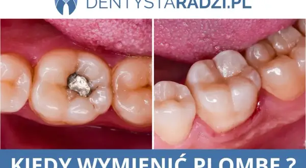 Opatrunek w zębie: Jak długo? Kiedy się martwić?