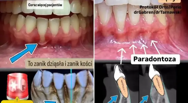 Zanikanie dziąseł i kości to paradontoza. Zobacz, jak odbudować dziąsła i kość, by uratować zęby.