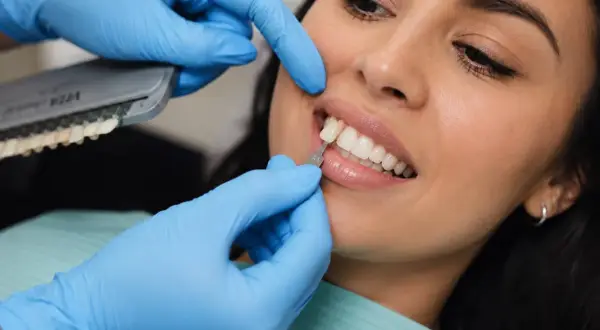 Dobór idealnego odcienia pasty do licówek kompozytowych. Dentysta porównuje kolor zębów pacjentki z wzornikiem.
