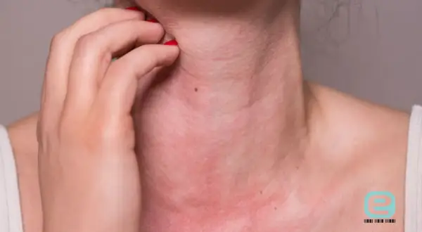 Alergia na nikiel w ustach: objawy, przyczyny i skuteczne leczenie