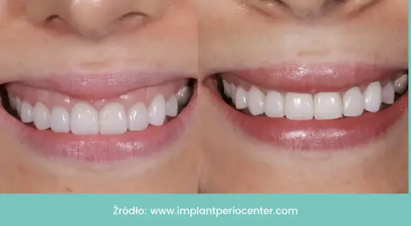 Uśmiech przed i po: zredukowany gummy smile, piękne, białe zęby.