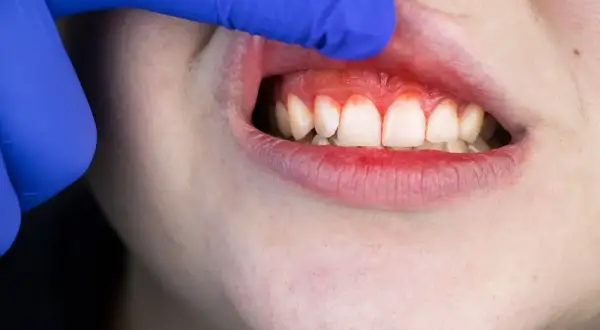 Torbiel na dziąśle: objawy, przyczyny i kiedy iść do dentysty