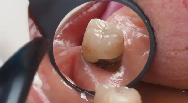 Widok zęba w lustrze dentystycznym. Widoczne dziąsło w dziurze zęba, z ciemnym wypełnieniem.