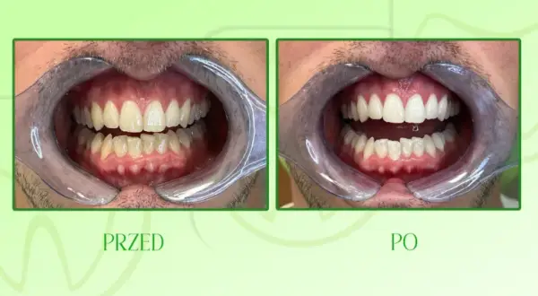Wybielanie zębów u dentysty: Czy warto? Cena, metody, efekty