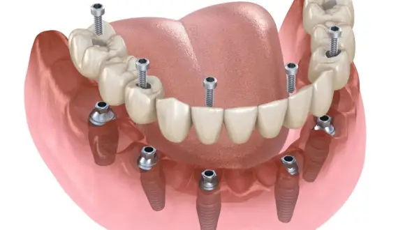 Koszt wstawienia 6 zęba: Ile zapłacisz za implant i most?