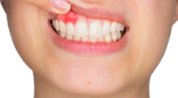 Krwawiące dziąsła: Szybkie sposoby, przyczyny i kiedy iść do dentysty