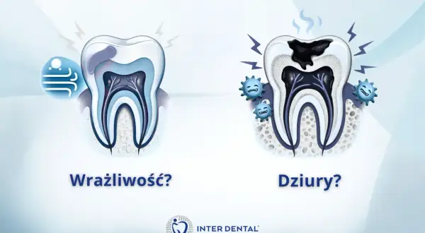 Wrażliwość zęba przy nagryzaniu? Zobacz, jak próchnica niszczy ząb, powodując ból.