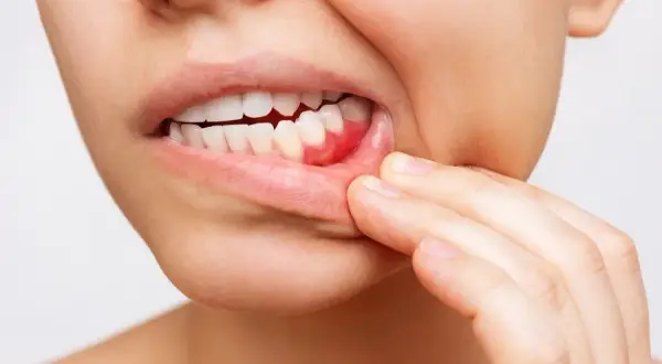 Ból dziąsła: Szybka ulga, przyczyny i kiedy iść do dentysty