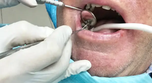 Dentysta usuwa korzeń zęba z ropą. Widoczne narzędzia stomatologiczne, lusterko i ślinociąg.