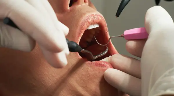 Dentysta usuwa szwy z dziąsła. Czy ściąganie szwów z dziąsła boli? Zależy od indywidualnego progu bólu.