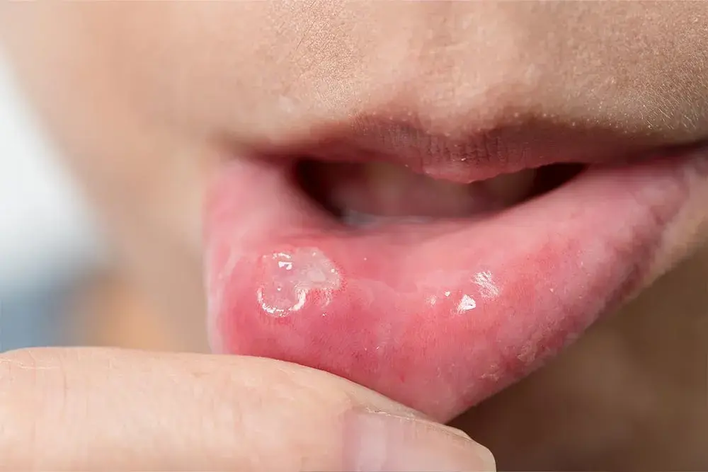 Afta u dentysty? Kiedy wizyta jest możliwa, a kiedy przełożyć?