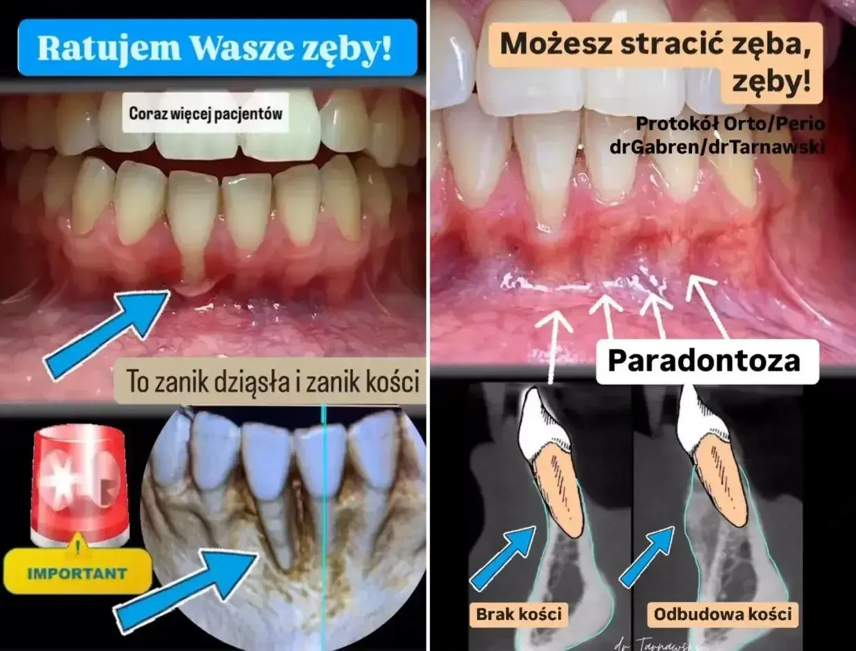 Zanikanie dziąseł i kości to paradontoza. Zobacz, jak odbudować dziąsła i kość, by uratować zęby.