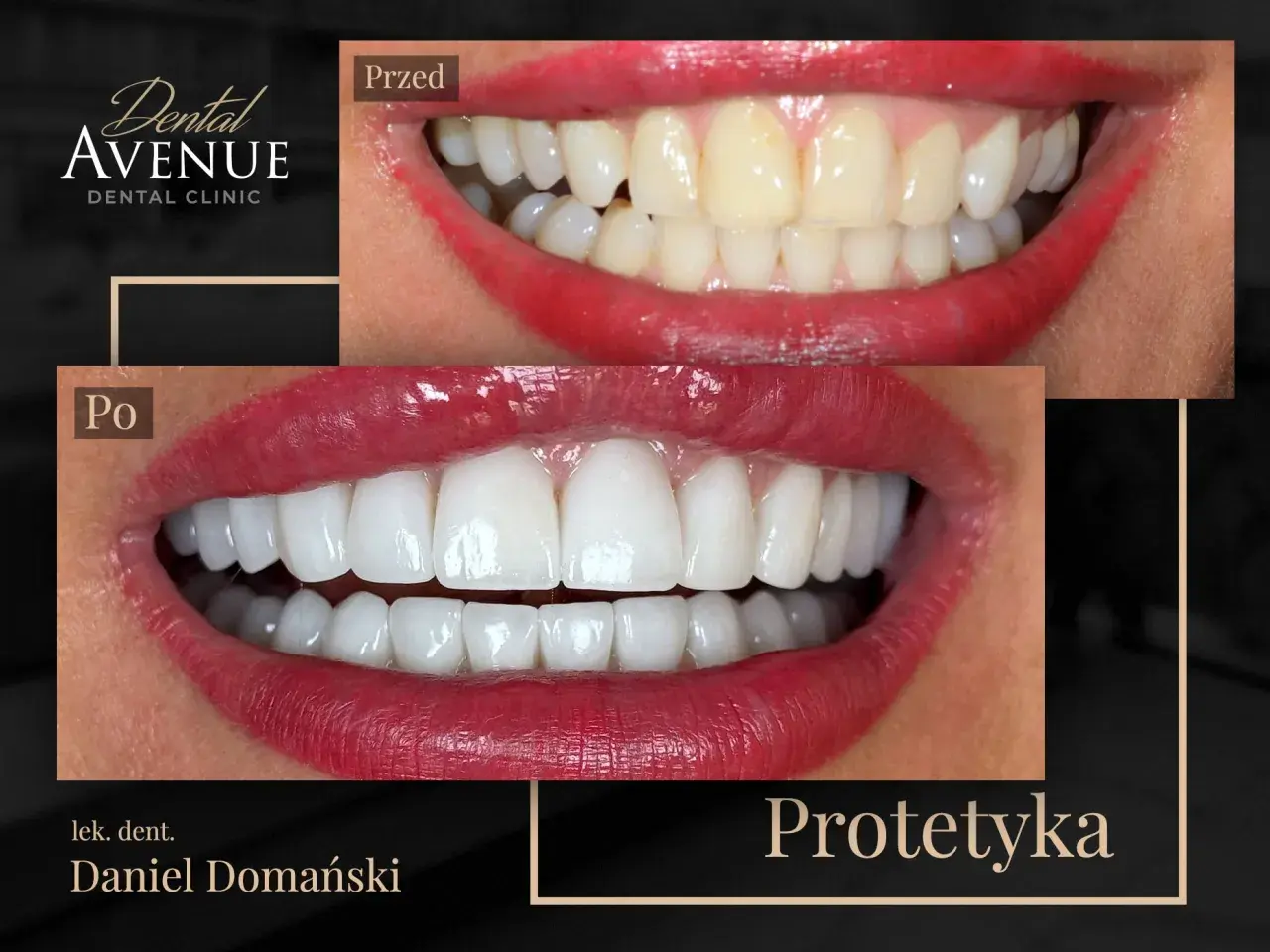 Przed i po: metamorfoza uśmiechu z licówkami porcelanowymi. Dowiedz się, licówki porcelanowe ile wytrzymują, by cieszyć się pięknym uśmiechem latami.