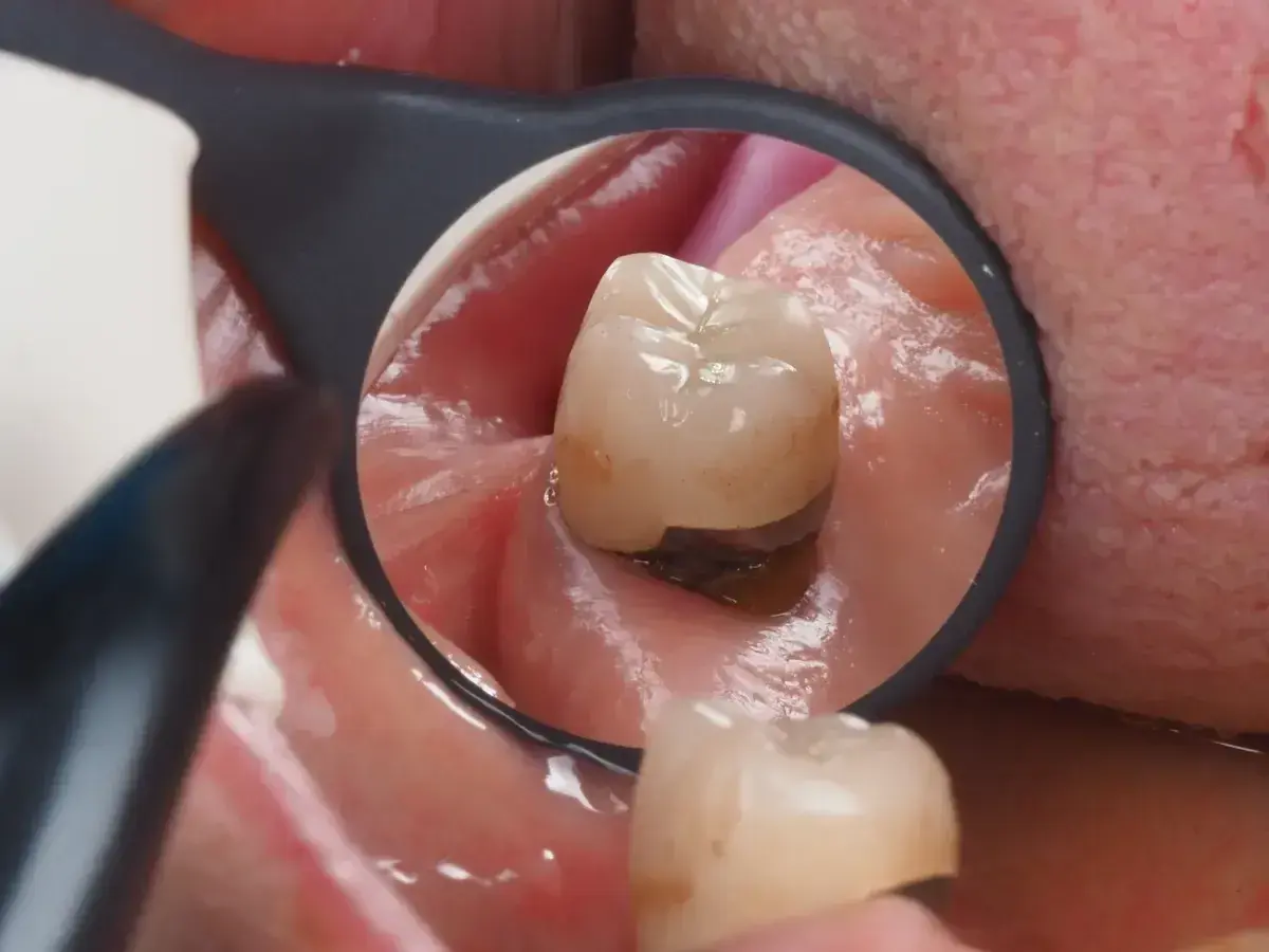 Widok zęba w lustrze dentystycznym. Widoczne dziąsło w dziurze zęba, z ciemnym wypełnieniem.