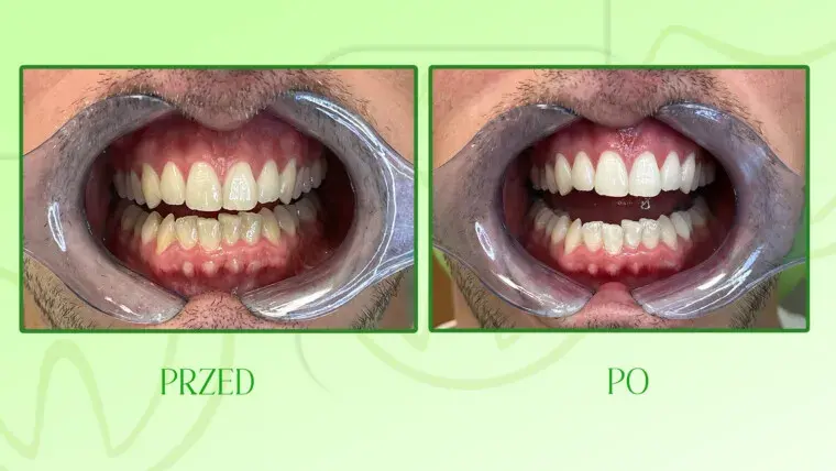 Wybielanie zębów u dentysty: Czy warto? Cena, metody, efekty