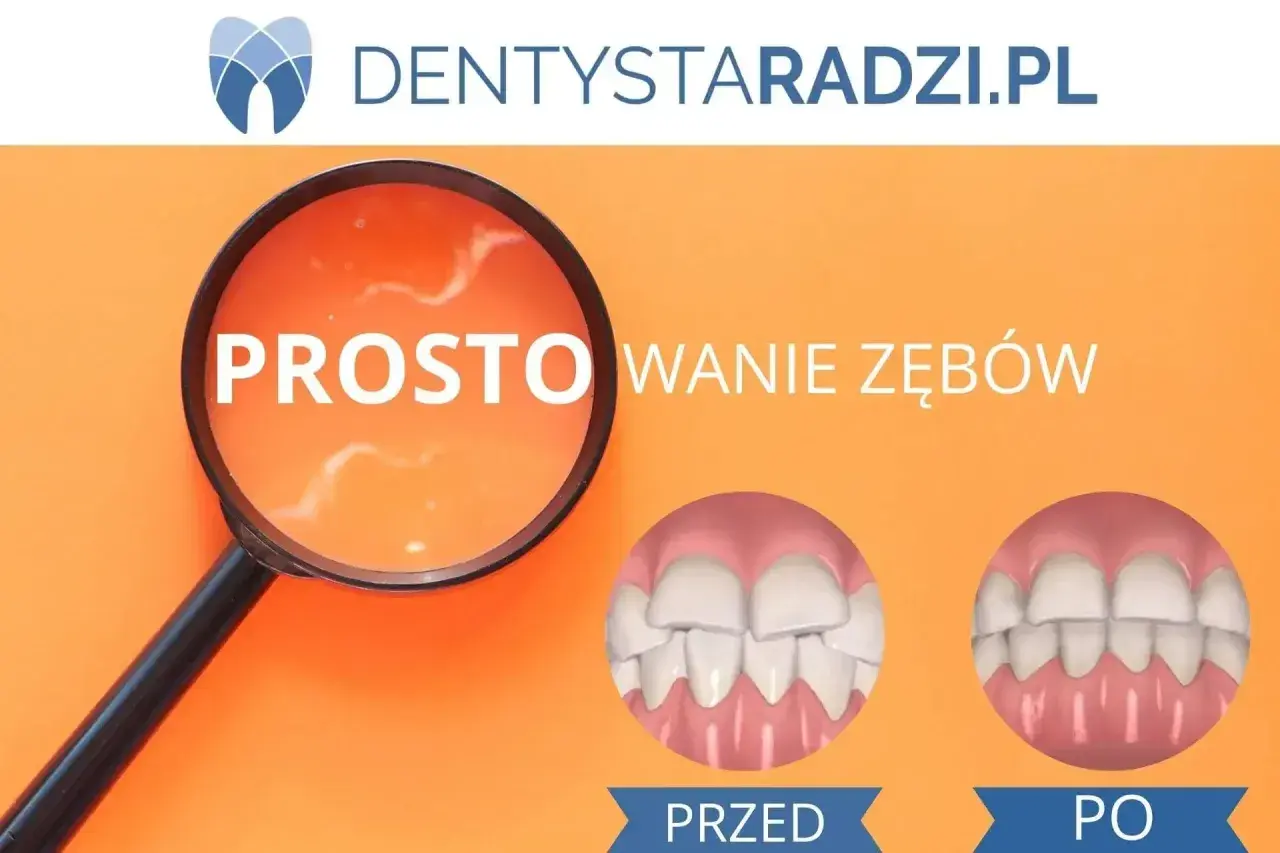 Proste licówki na krzywe zęby. Zobacz metamorfozę uśmiechu przed i po zabiegu.