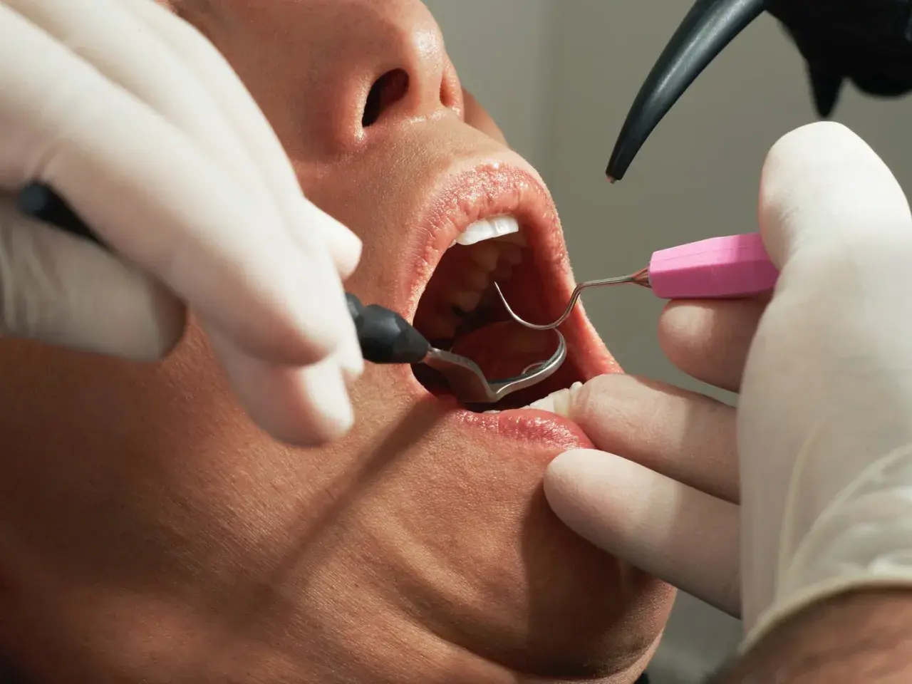 Dentysta usuwa szwy z dziąsła. Czy ściąganie szwów z dziąsła boli? Zależy od indywidualnego progu bólu.
