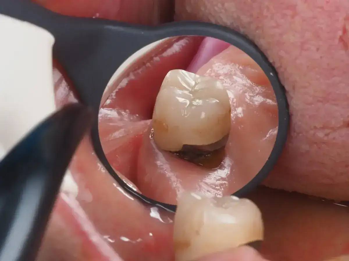Widok zęba w lustrze dentystycznym. Widoczne dziąsło w dziurze zęba, z ciemnym wypełnieniem.
