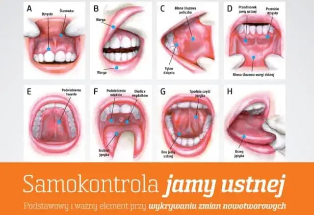 czynniki ryzyka raka jamy ustnej