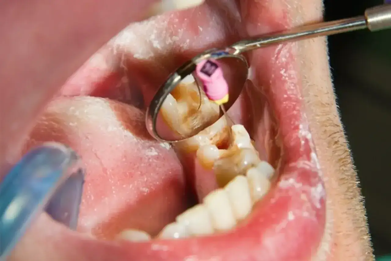Dentysta pracuje nad martwym zębem, używając narzędzi i lusterka. Czy warto go usuwać?