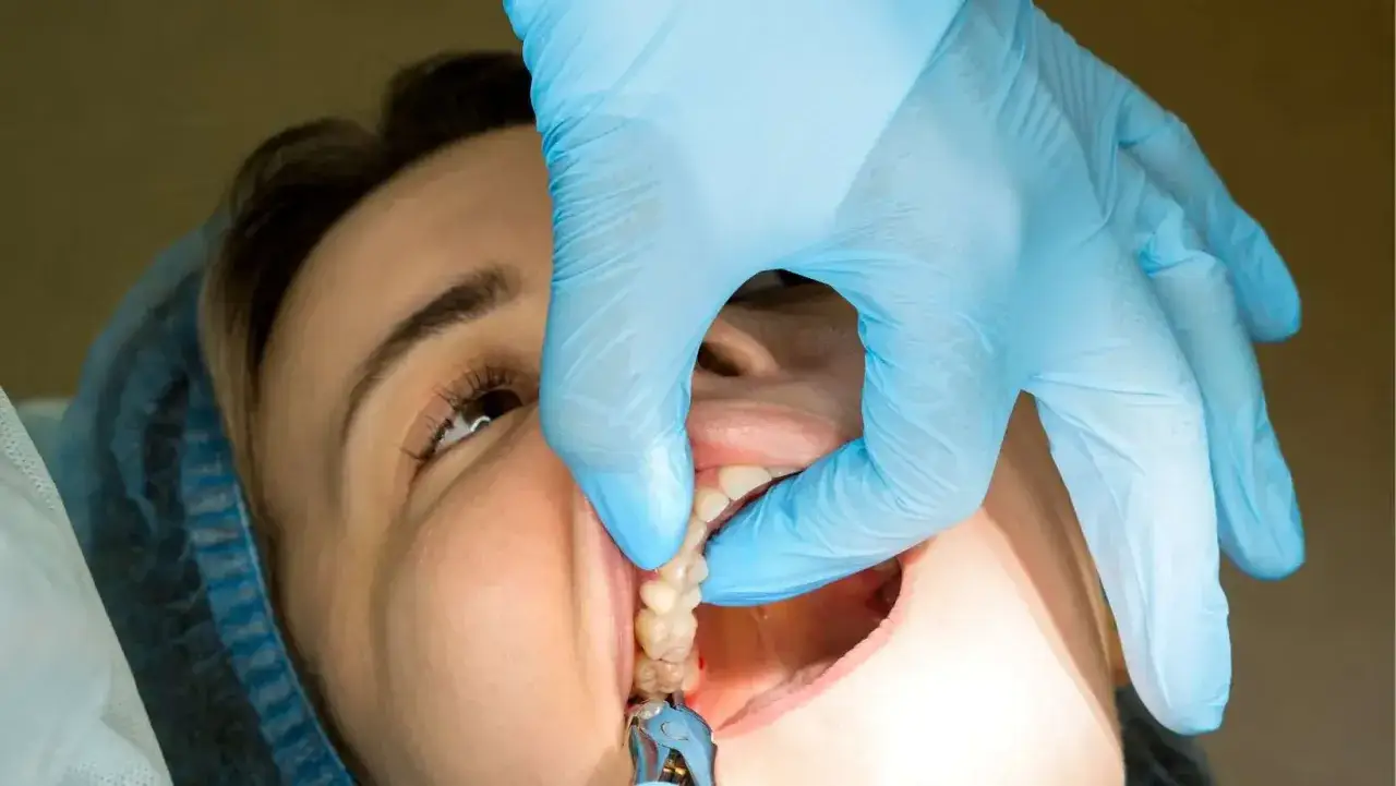 Dentysta usuwa szwy z dziąsła. Czy ściąganie szwów z dziąsła boli? Zależy od indywidualnego progu bólu i zastosowanego znieczulenia.