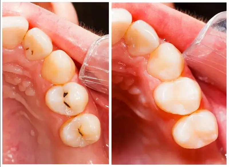dentysta leczenie pr&oacute;chnicy