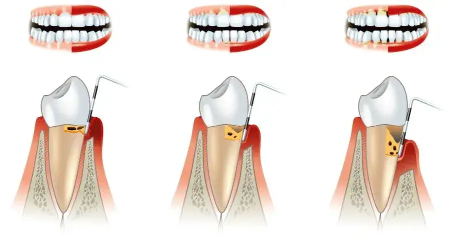 Profesjonalne zabiegi periodontologiczne