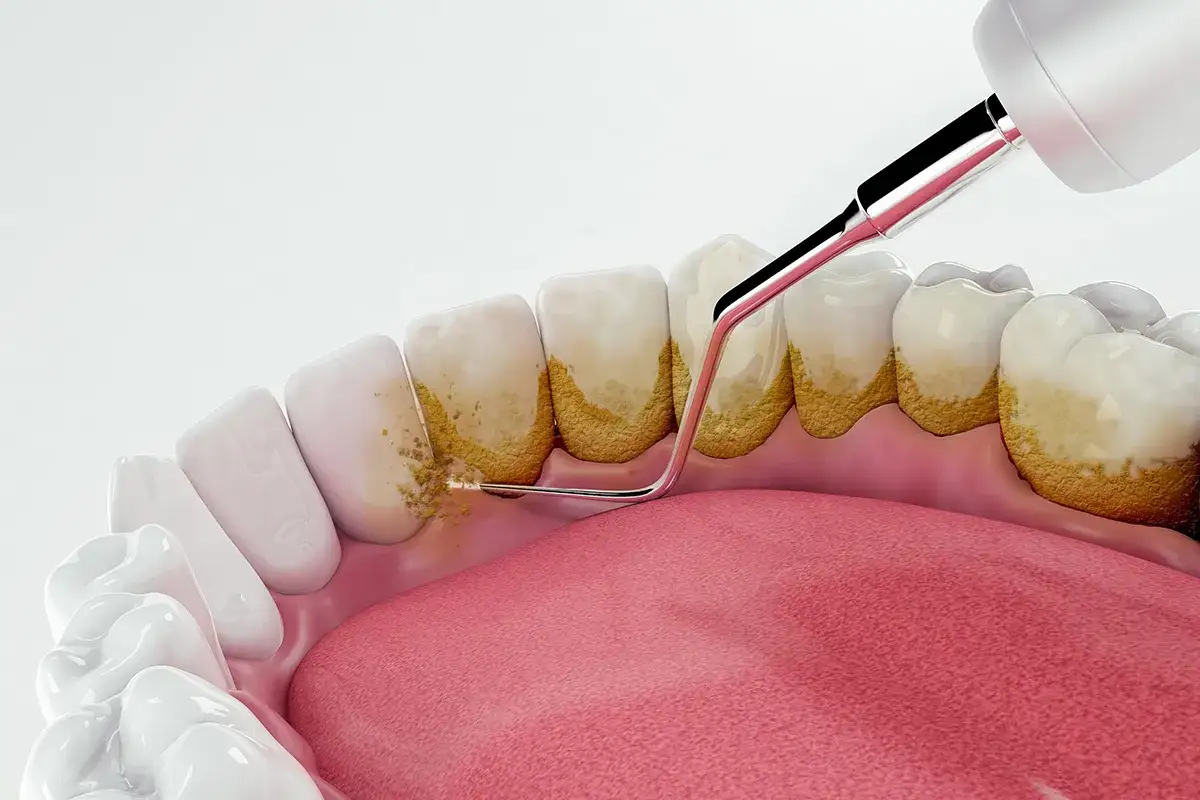 dentysta usuwanie kamienia nazębnego