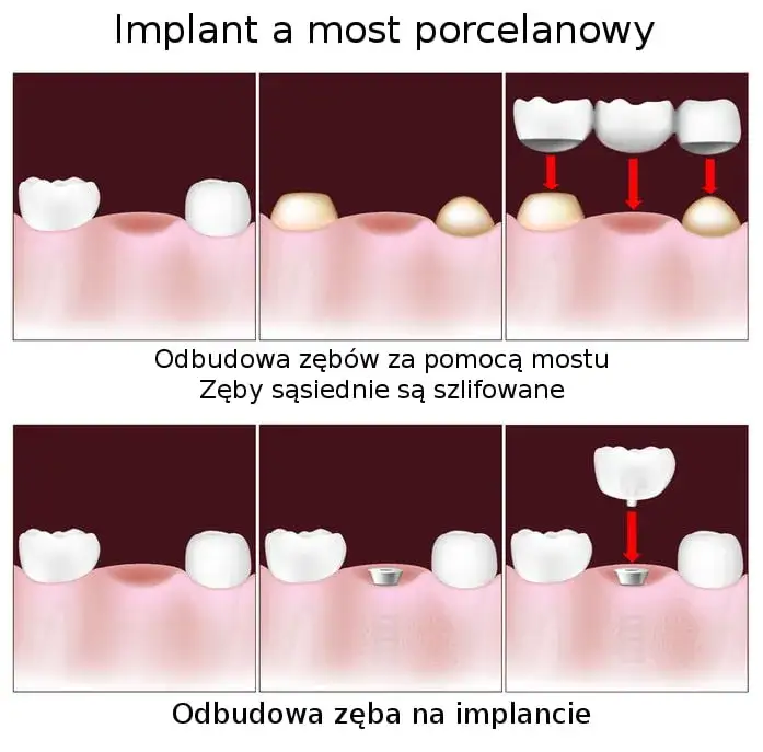 por&oacute;wnanie metod uzupełnienia braku zęba implant most proteza