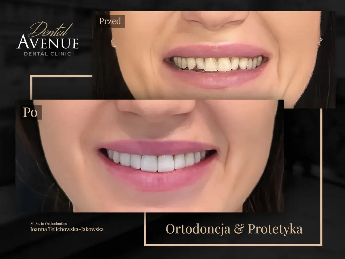 Przed i po: metamorfoza uśmiechu. Bonding na krzywe zęby przyniósł spektakularny efekt.