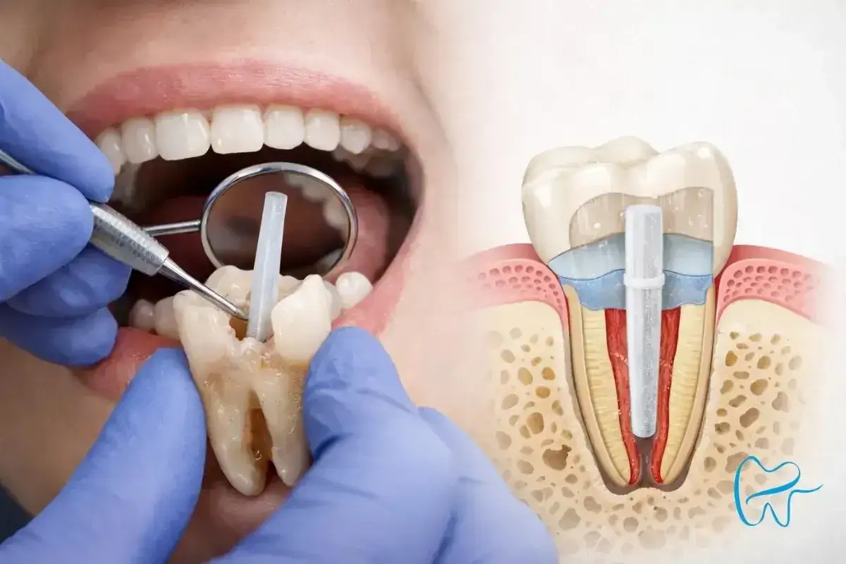 Dentysta umieszcza wkład koronowo-korzeniowy, kluczowy etap w nadlewaniu zębów, by przywrócić ich funkcjonalność i estetykę.