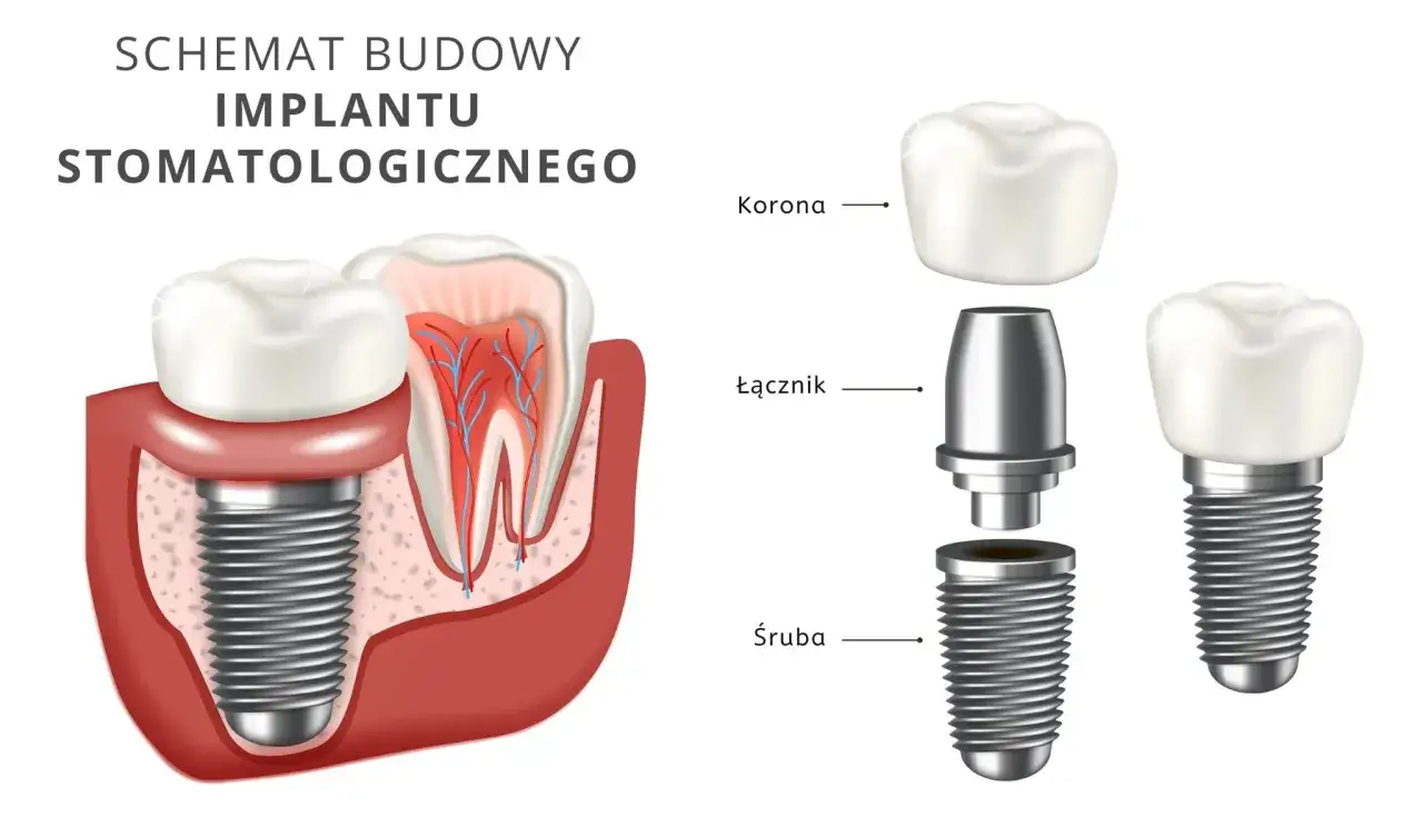 etapy wstawiania implantu zęba koszty