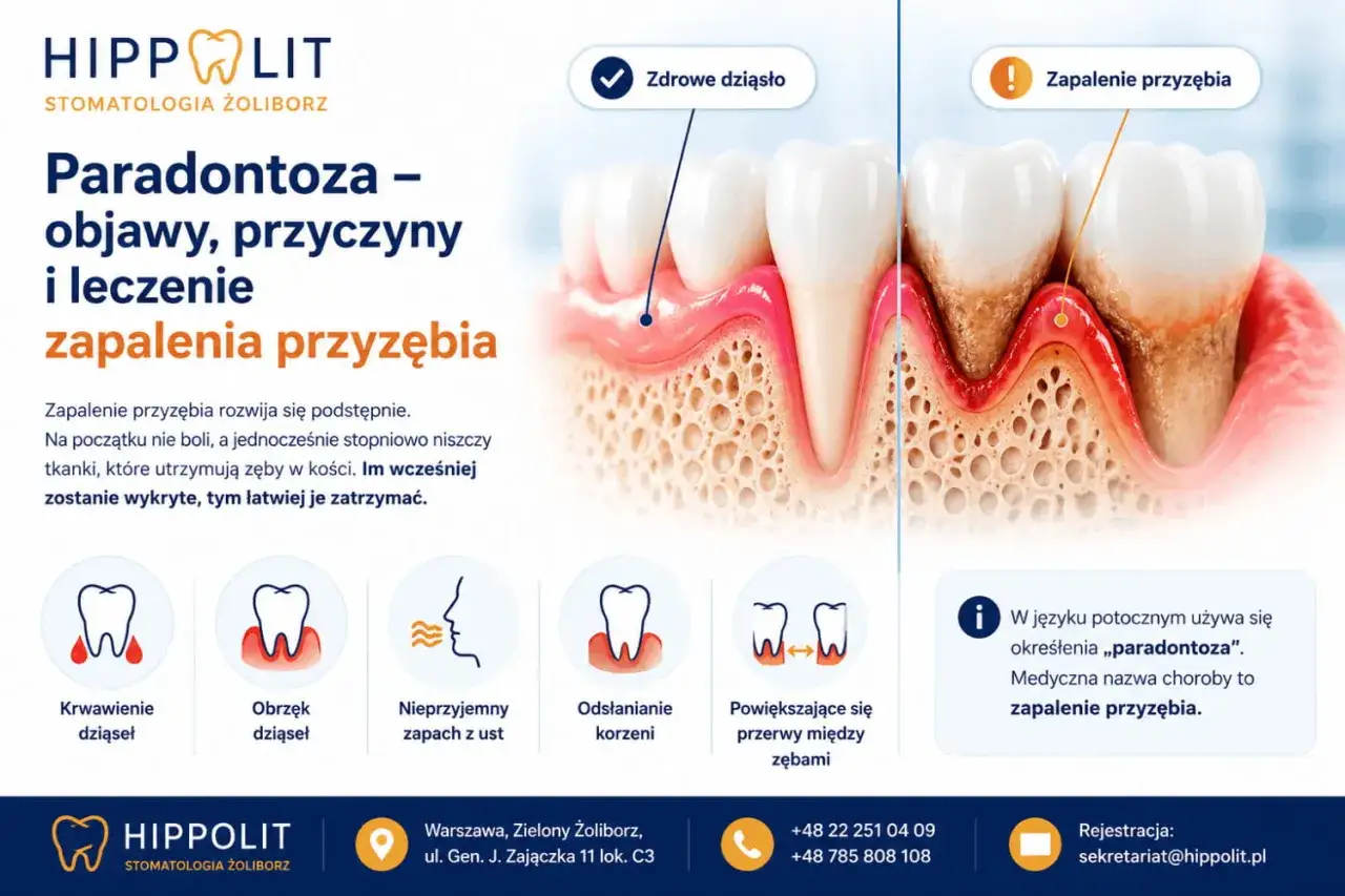 Ilustracja pokazuje zdrowe i chore dziąsła, wyjaśniając objawy zapalenia przyzębia (paradontozy).