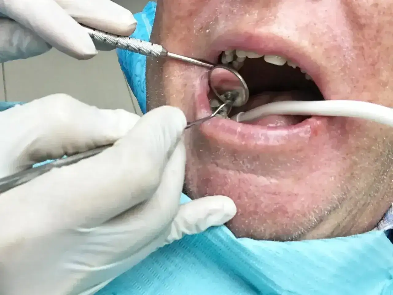 Dentysta usuwa korzeń zęba z ropą, używając narzędzi i lusterka.