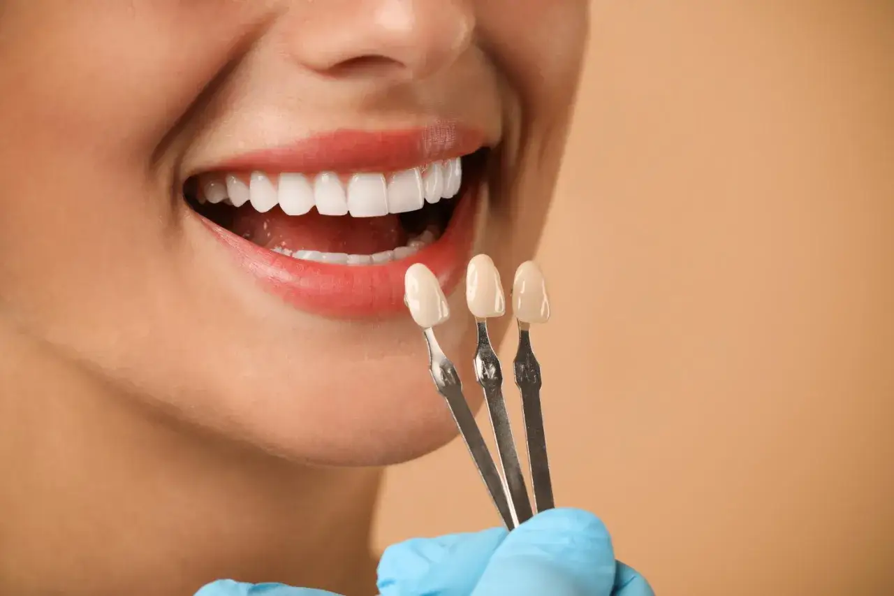 Uśmiechnięta kobieta z idealnymi zębami, dentysta dobiera odcień pasty do licówek kompozytowych.