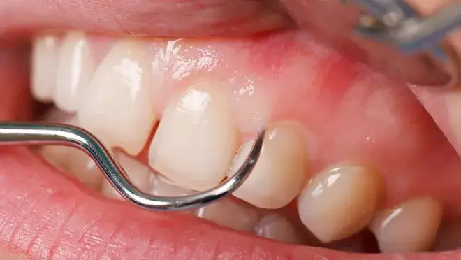 kiedy iść do dentysty z bólem dziąsła