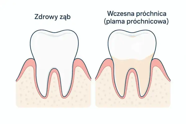 Porównanie zdrowego zęba i zęba z wczesną próchnicą. Szybkie leczenie próchnicy jest kluczowe.