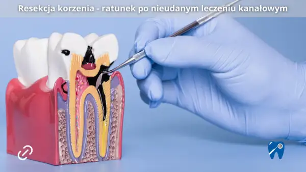 Model zęba z widocznym uszkodzeniem korzenia, nad którym pracuje stomatolog. To przykład sytuacji, gdzie resekcja zęba jest ratunkiem po nieudanym leczeniu kanałowym.