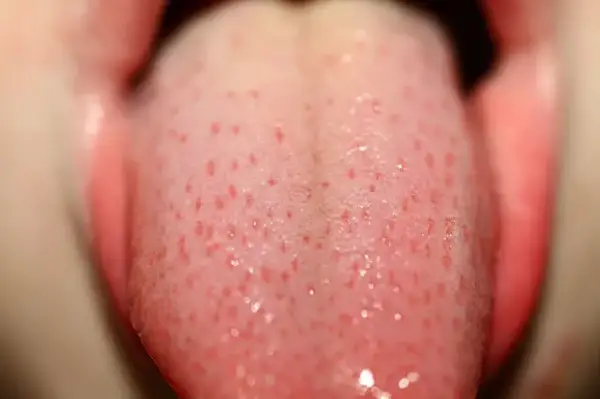 Objawy HPV w jamie ustnej i gardle: objawy, ryzyko, leczenie