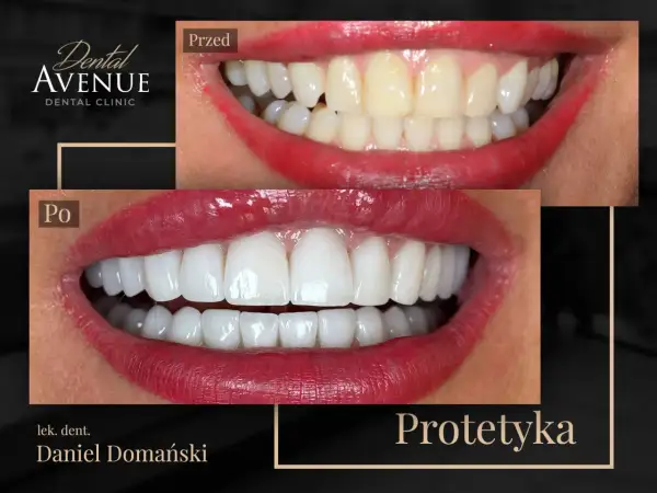 Przed i po: metamorfoza uśmiechu z licówkami porcelanowymi. Dowiedz się, licówki porcelanowe ile wytrzymują, by cieszyć się pięknym uśmiechem latami.