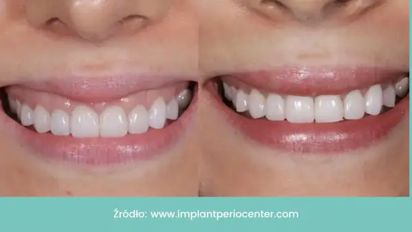 Uśmiech przed i po: zredukowany gummy smile, piękne, białe zęby.
