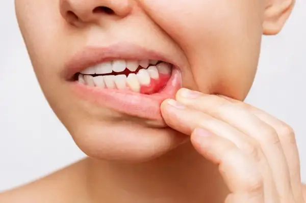 Ból dziąsła: Szybka ulga, przyczyny i kiedy iść do dentysty
